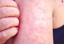 Measles outbreak, naideklara sadiay Lanao Del Sur, Maguindanao Del Norte ken Sulu
