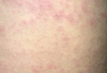 Region 1 malayo pa sa epidemic threshold ng tigdas