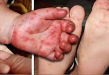 City Health Office Hugot nga nakatutok sa kaso sa HFMD sa dakbayan