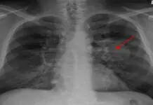 Nagasuprer sang lung cancer, kalabanan naga-edad 70-anyos santo sa isa ka pagtuon