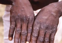 WHO, gin-athag nga indi makumpara sa COVID-19 ang bag-o nga mpox outbreak