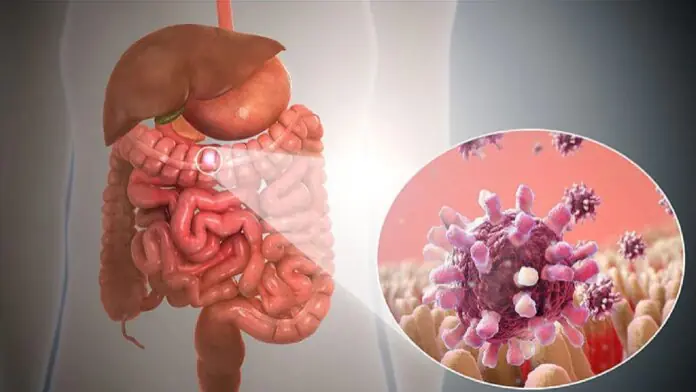 GASTROENTERITIS