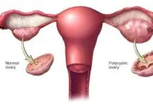 Walo tubtob 13 ka porysento sang kababainhan sa bilog nga kalibutan,naga-ekspersyensya sang polycystic ovary syndrome (PCOS)