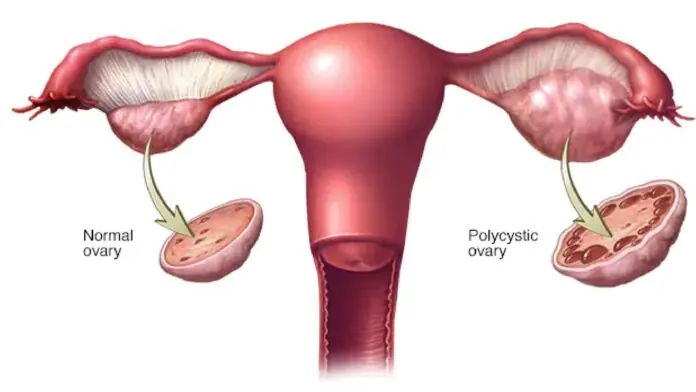 OVARY