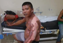 Vlogger sa Calinog, Iloilo nga ginsindihan ang kaugalingon para sa vlog, nag-angkon sang third degree burn