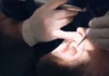 Pilas kag singaw sa baba nga nagadugay na tubtob duha ka semana, posible senyales sang oral cancer