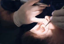 Pilas kag singaw sa baba nga nagadugay na tubtob duha ka semana, posible senyales sang oral cancer