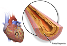 Ischemic heart disease, top killer sa 2020, 2021