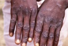 WHO, nagpaandam angot sa monkeypox