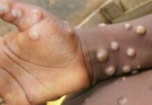 Mga close contact it daywang indibidwal nga nakaangkon it monkeypox sa Australia, padayun nga gina-monitor