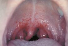 Strep throat ukon bacteria sa tutunlan , aton nga pagasayuron