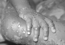 Bag-ong sintomas it monkeypox sa UK, ginatutukan