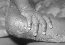 WHO, haum magsuporta sa nasyon kontra sa monkeypox