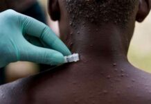 Monkeypox virus, nagkalhit eon sa 75 ka mga nasyon