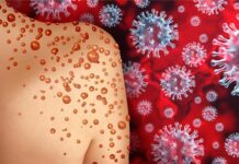 Estados Unidos, gindeklara ro monkeypox virus bilang sangka public health emergency
