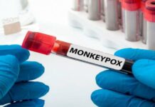 Kaso it monkeypox sa Spain, sigidas ro pagtaas