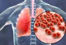 Pneumonia, nagapangaywa sa mga rason it pagka-ospital it maabu nga mga pumueoyo