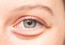 Mga pamaagi agud nga malikawan ro pag angkon it eye bags