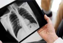 Lung cancer, pinaka-common nga rason it cancer sa haeos bilog nga kalibutan