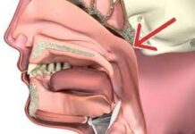 Pilang pamaagi agud nga malikawan ro canton tumor