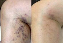 Solusyon sa varicose veins
