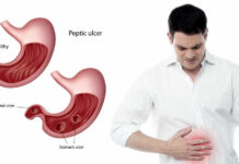Ano ro mga senyales it ulcer