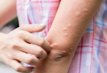 Publiko ginapadahan it mga eksperto sa sakit nga Japanese Encephalitis
