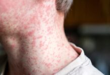 DOH, kinumpirma ti panagngato ti kaso ti measles-rubella ditoy Pilipinas