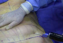 Businesswoman dies after liposuction procedure in Makati liposuction
