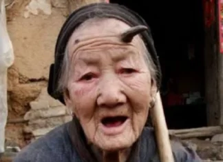 101-anyos nga tigulang, gintubuan sang sungay sa iya nga agtang