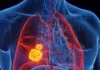 80-90% sang mga kaso sang lung cancer, may kaangtanan sa pagpanigarilyo kag secondhand smoke — public health expert