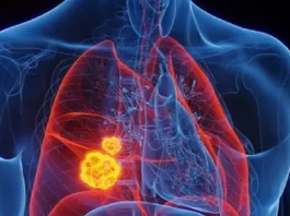 80-90% sang mga kaso sang lung cancer, may kaangtanan sa pagpanigarilyo kag secondhand smoke — public health expert