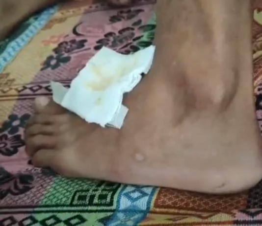 Maaramid nu makagat iti uleg, inlawlawag ti maysa a health officer